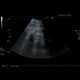 Myelolipoma, adrenal: US - Ultrasound